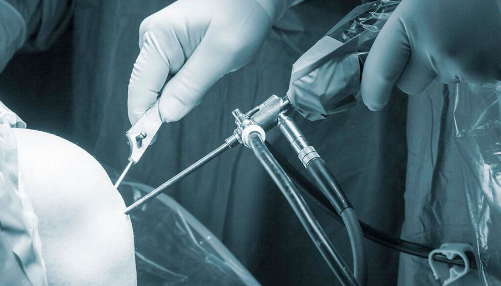 Arthroscopic Debridement