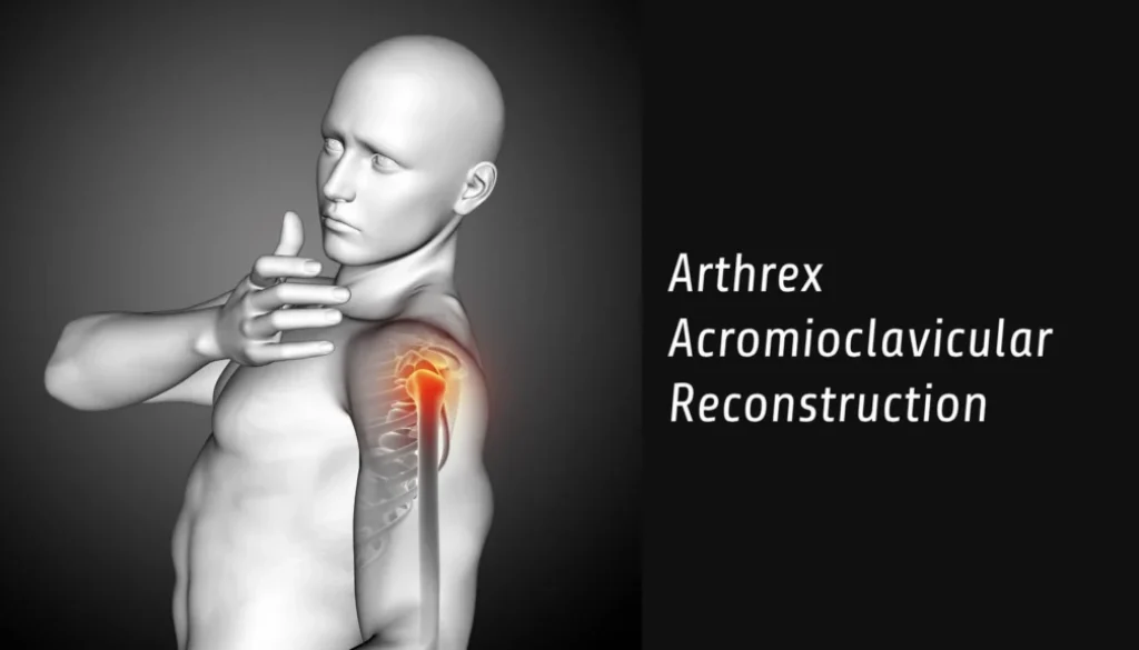 Arthrex Acromioclavicular Reconstruction Techniques
