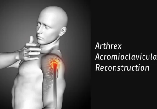 Arthrex Acromioclavicular Reconstruction Techniques: A Guide