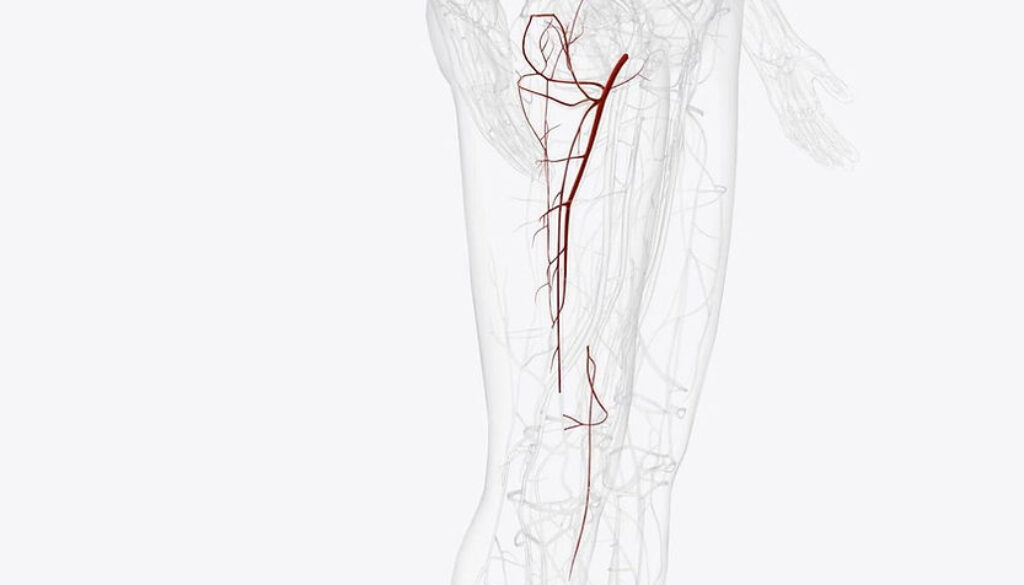 Stages of Avascular Necrosis