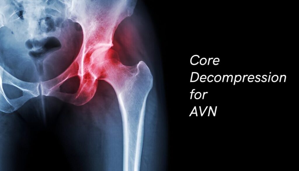Core Decompression for AVN
