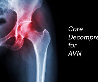 Core Decompression for AVN