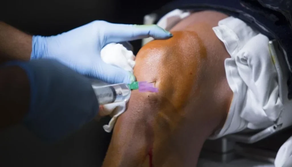 Stem Cell ACL Repair