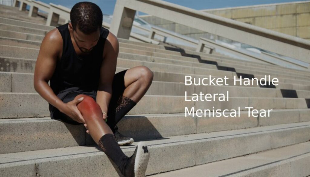 Bucket Handle Lateral Meniscal Tear