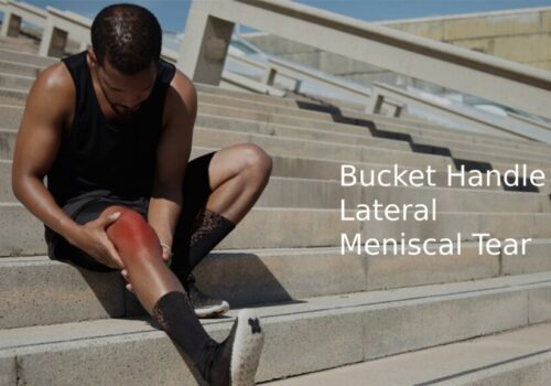 Bucket Handle Lateral Meniscal Tear: Complete Treatment Guide