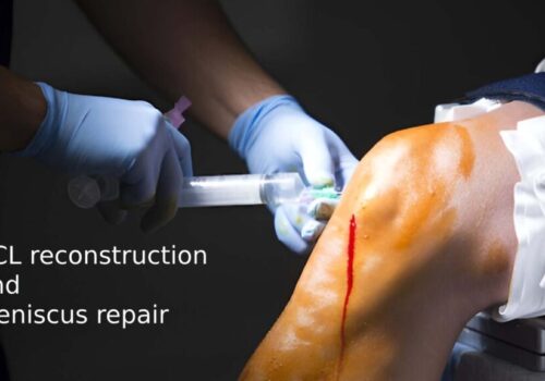 ACL Reconstruction and Meniscus Repair: The Ultimate Guide